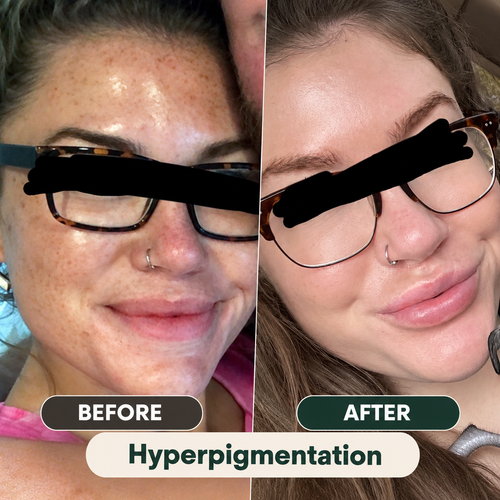 Kojic Acid Turmeric Pad